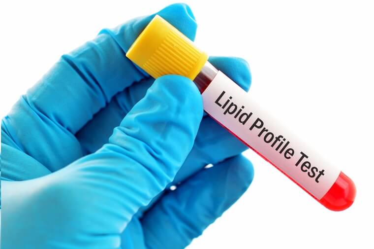 Book Lipid Profile Test in Hyderabad