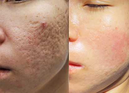 Acne Scar Treatment in Noida