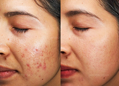 Acne Treatment in Noida