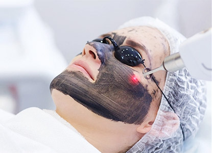 Carbon Laser Facial in Noida