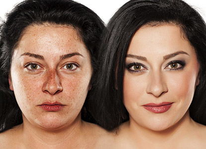 Freckles Laser Treatment in Noida