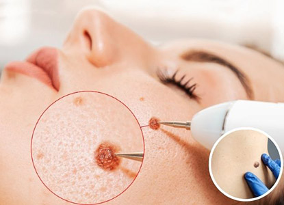 Mole and Wart Removal Treatment in Noida