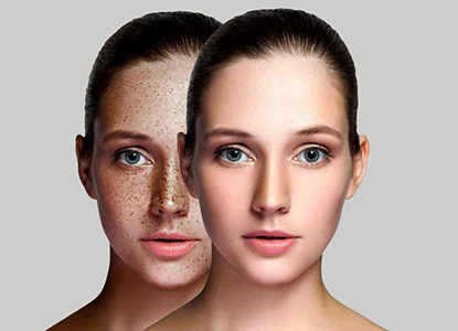 Pigmentation Removal Treatment in Dwarka Delhi, Best Pigmentation Removal Treatment in Dwarka Delhi, Top Pigmentation Removal Treatment in Dwarka Delhi, Affordable Pigmentation Removal Treatment in Dwarka Delhi, Low Cost Pigmentation Removal Treatment in Dwarka Delhi, Pigmentation Removal Treatment Price in Dwarka Delhi, Pigmentation Removal Treatment Package in Dwarka Delhi, Pigmentation Removal Treatment Price in Dwarka Delhi, Pigmentation Removal Treatment Clinic in Dwarka Delhi, Pigmentation Removal Treatment Doctor in Dwarka Delhi, Pigmentation Removal Treatment Dentist in Dwarka Delhi