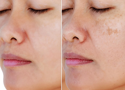 Pigmentation Treatment in Noida