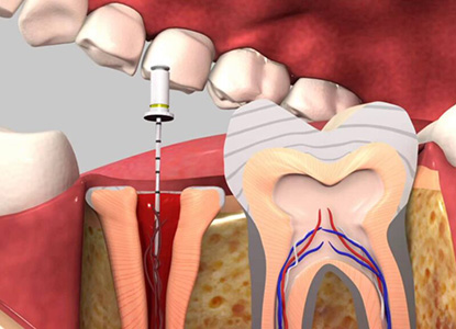 Post and Core Dental Treatment in Dwarka Delhi, Dental Post and Core Dental Treatment in Dwarka Delhi, Best Post and Core Dental Treatment in Dwarka Delhi, Top Post and Core Dental Treatment in Dwarka Delhi, Affordable Post and Core Dental Treatment in Dwarka Delhi, Low Cost Post and Core Dental Treatment in Dwarka Delhi, Post and Core Dental Treatment Price in Dwarka Delhi, Post and Core Dental Treatment Package in Dwarka Delhi, Post and Core Dental Treatment Price in Dwarka Delhi, Post and Core Dental Treatment Clinic in Dwarka Delhi, Post and Core Dental Treatment Doctor in Dwarka Delhi, Post and Core Dental Treatment Dentist in Dwarka Delhi