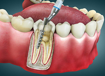 Root Canal Treatment in Dwarka Delhi, Dental Root Canal Treatment in Dwarka Delhi, Best Root Canal Treatment in Dwarka Delhi, Top Root Canal Treatment in Dwarka Delhi, Affordable Root Canal Treatment in Dwarka Delhi, Low Cost Root Canal Treatment in Dwarka Delhi, Root Canal Treatment Price in Dwarka Delhi, Root Canal Treatment Package in Dwarka Delhi, Root Canal Treatment Price in Dwarka Delhi, Root Canal Treatment Clinic in Dwarka Delhi, Root Canal Treatment Doctor in Dwarka Delhi, Root Canal Treatment Dentist in Dwarka Delhi