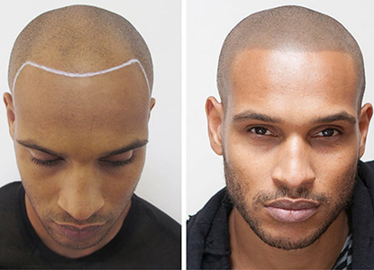 Scalp Micropigmentation Treatment in Noida