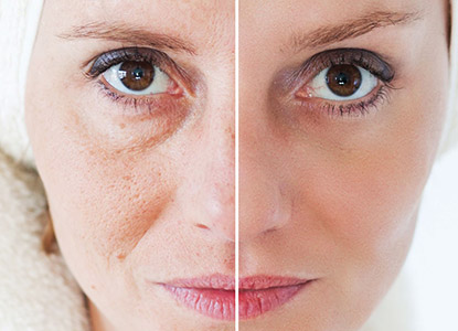 Skin Rejuvenation Treatment in Noida