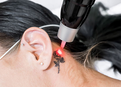 Tattoo Removal in Noida