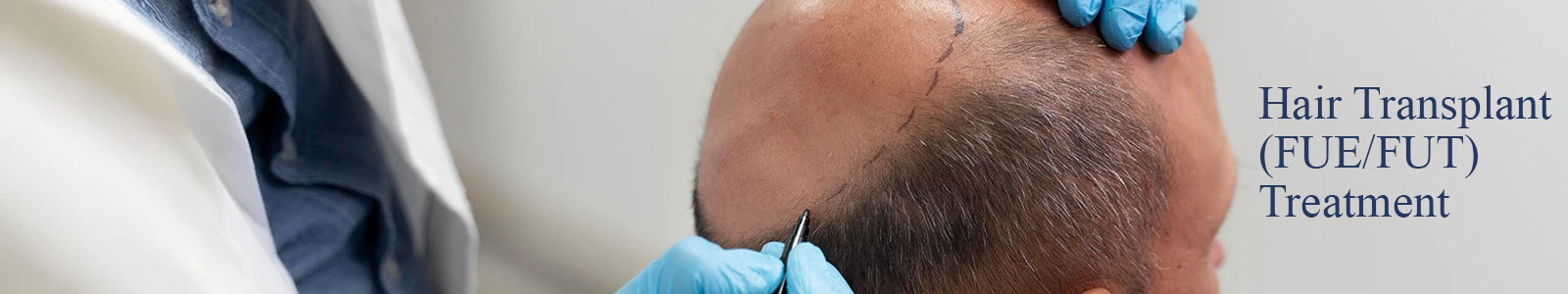 Hair Transplant (FUE/FUT) Treatment