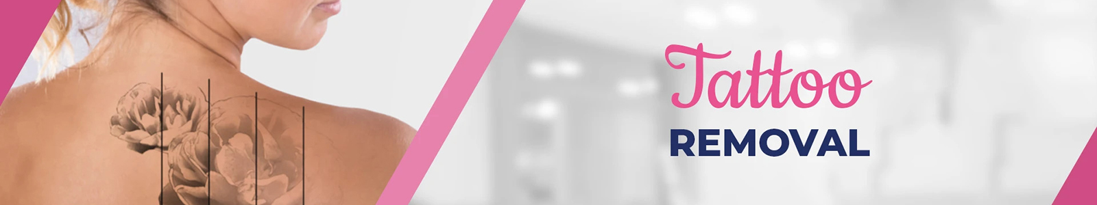 Tattoo Removal Treatment