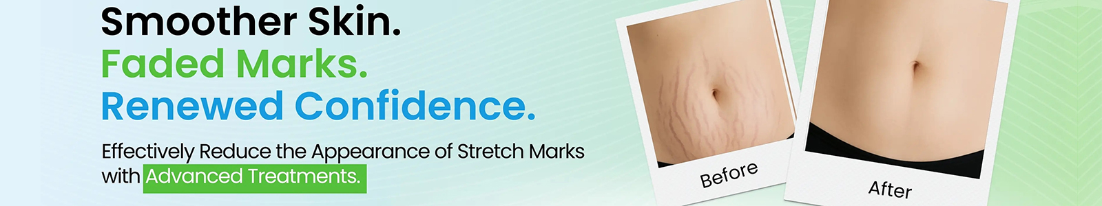 Stretch Mark Reduction Treatment